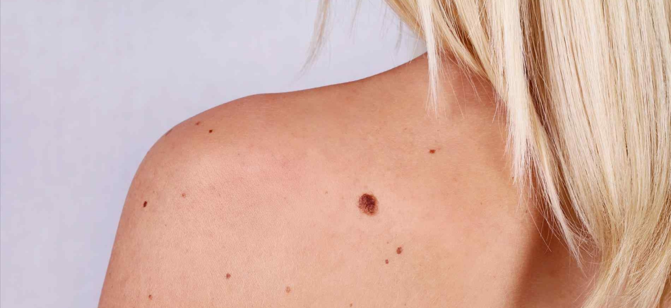 Родинка на плече