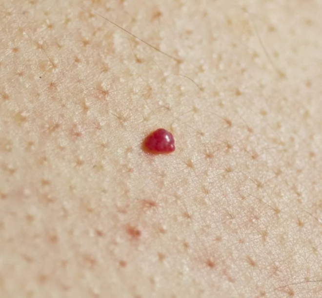 Сосудистая родинка