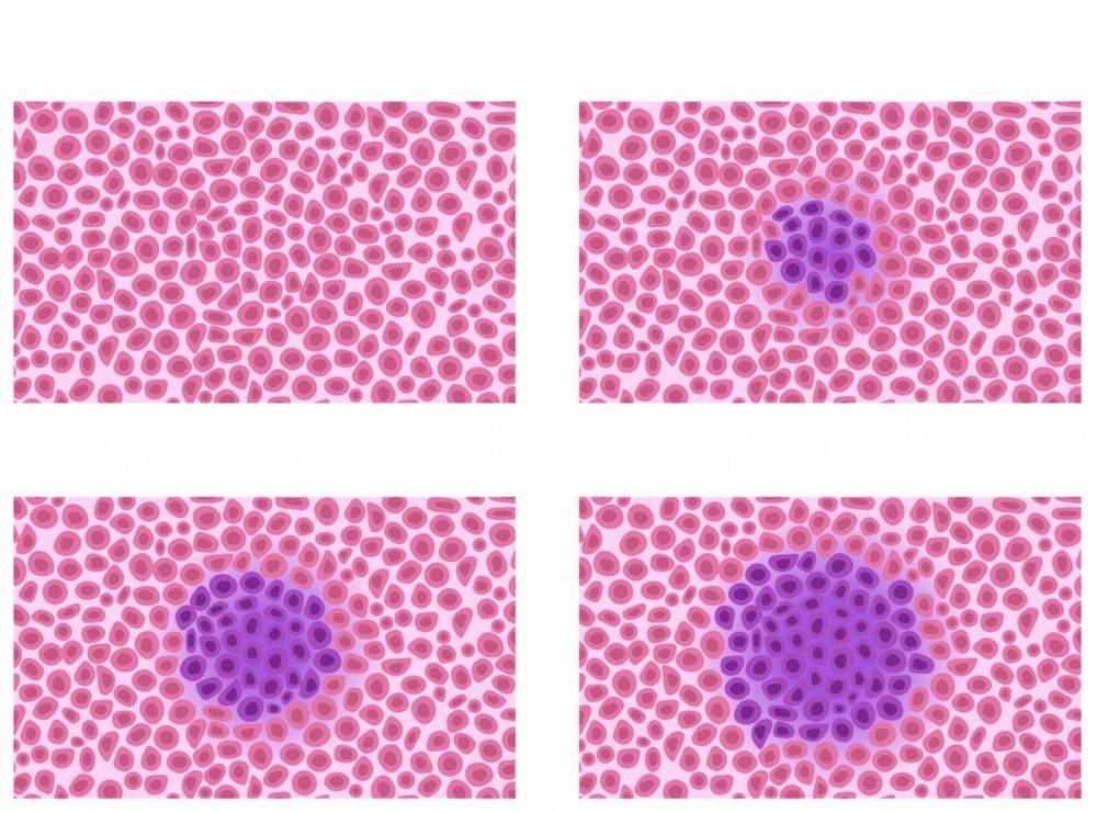 Стадирование опухолей по международной классификации TNM