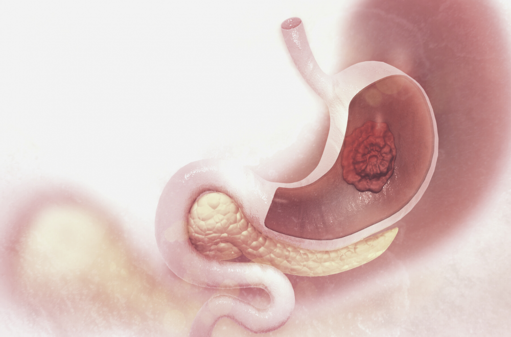 Рак желудка