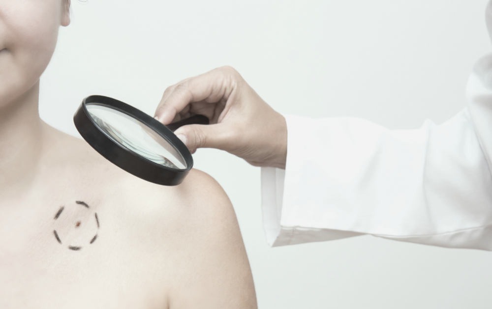 Меланома кожи