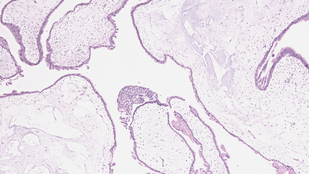 Трофобластические опухоли