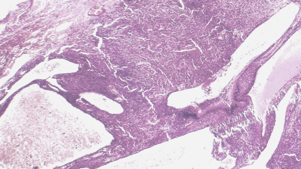 Метастазы злокачественных опухолей без выявленного первичного очага