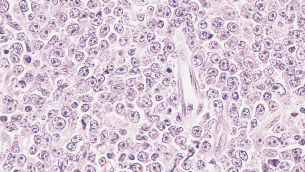 Лимфома Ходжкина