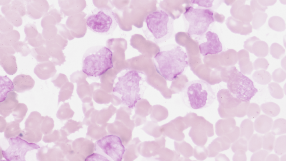 Острые лейкозы