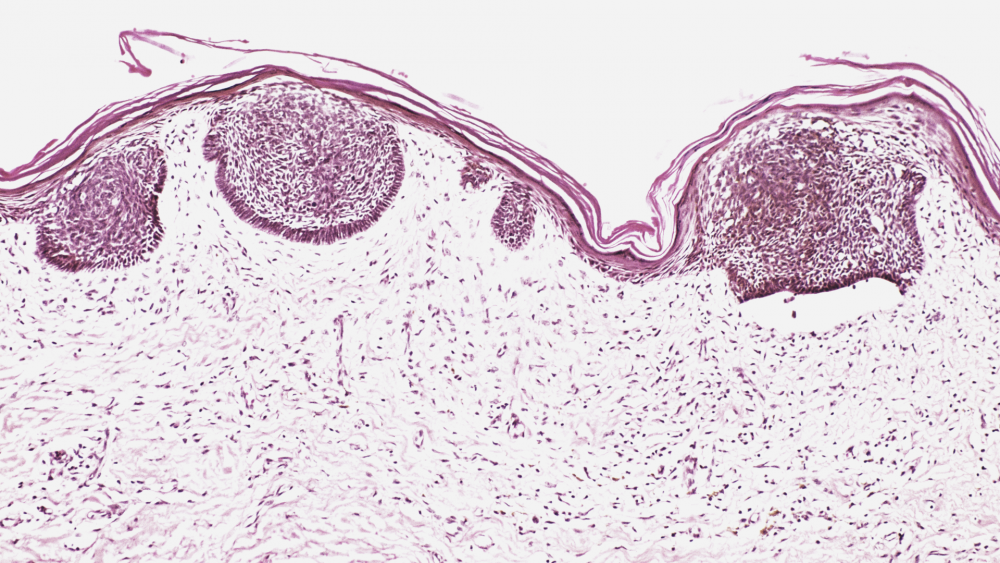 Карцинома Меркеля